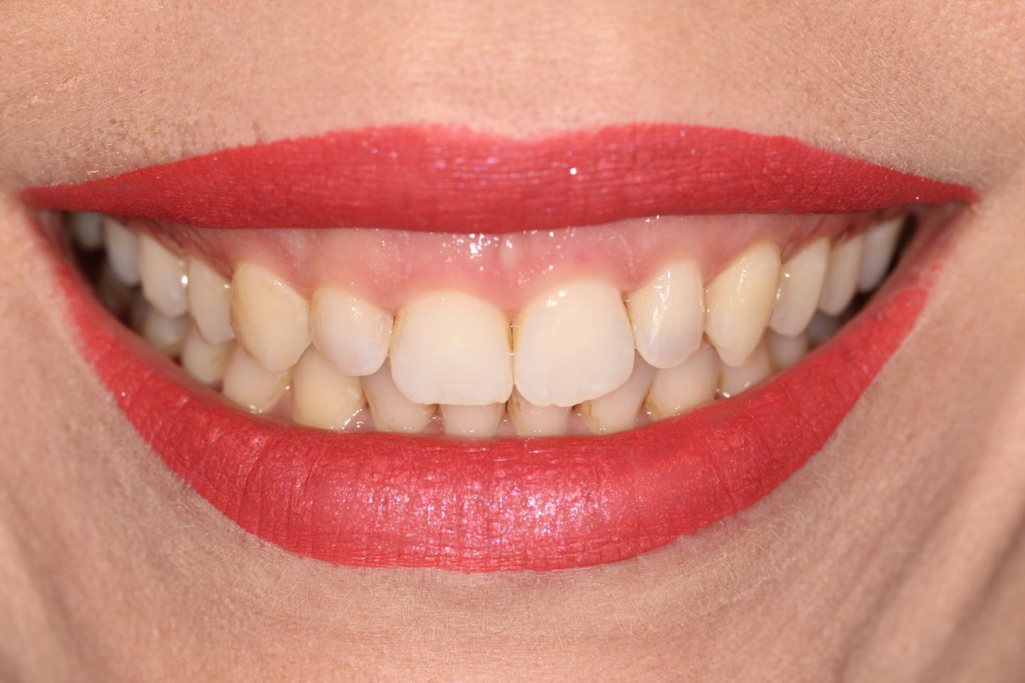 Amy - Invisalign and whitening