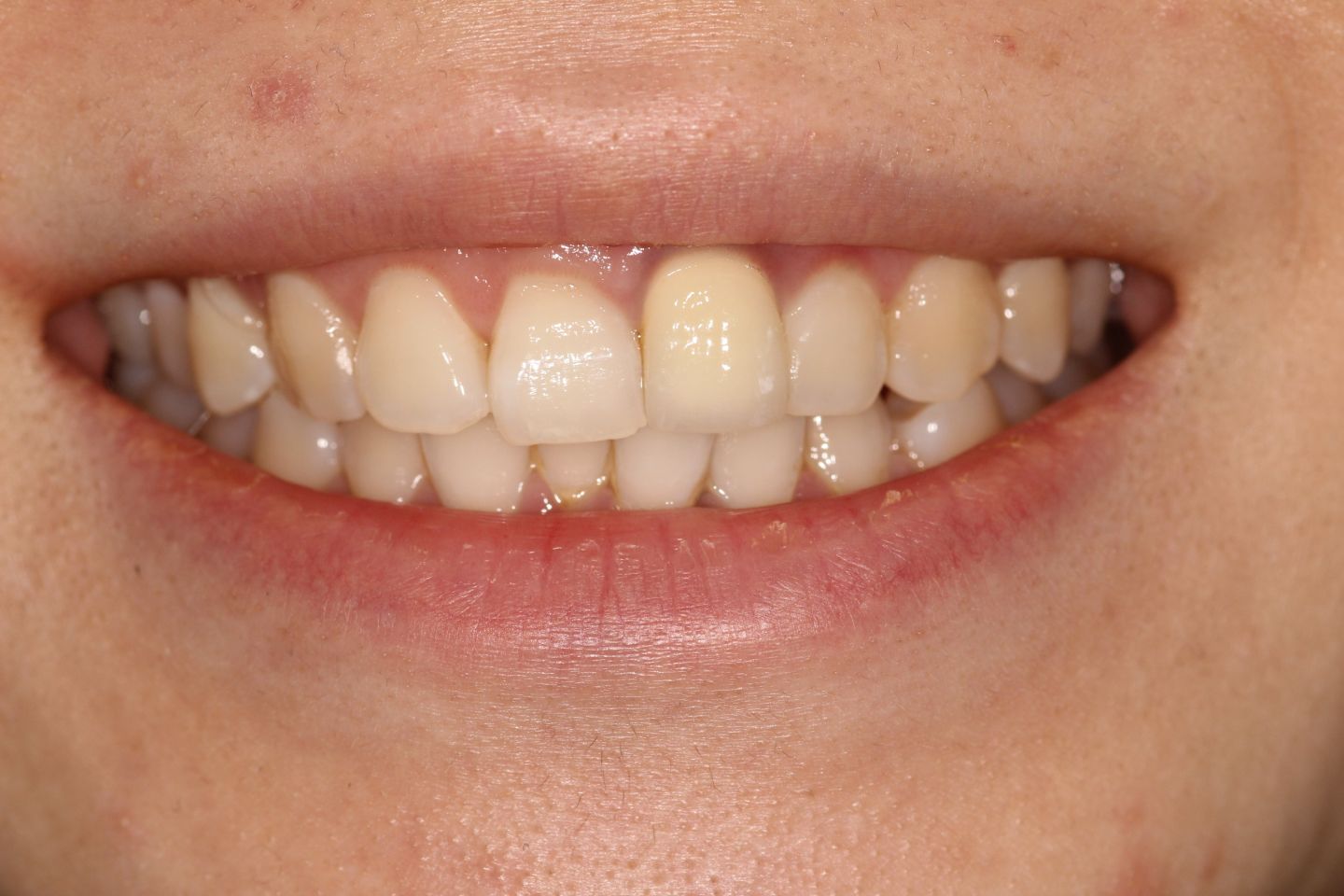 Annabelle - Invisalign, whitening, iTero and crown