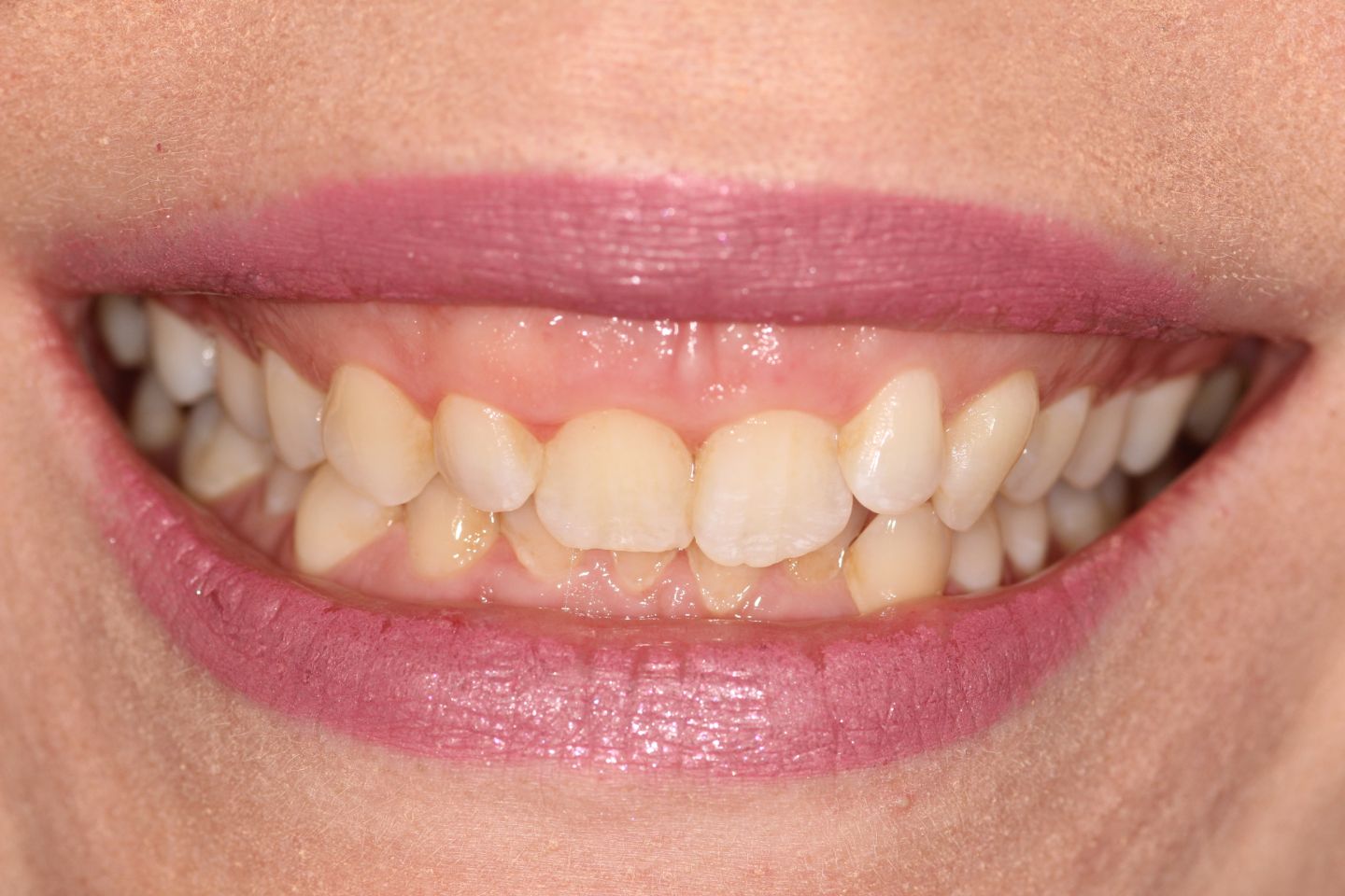 Amy - Invisalign and whitening