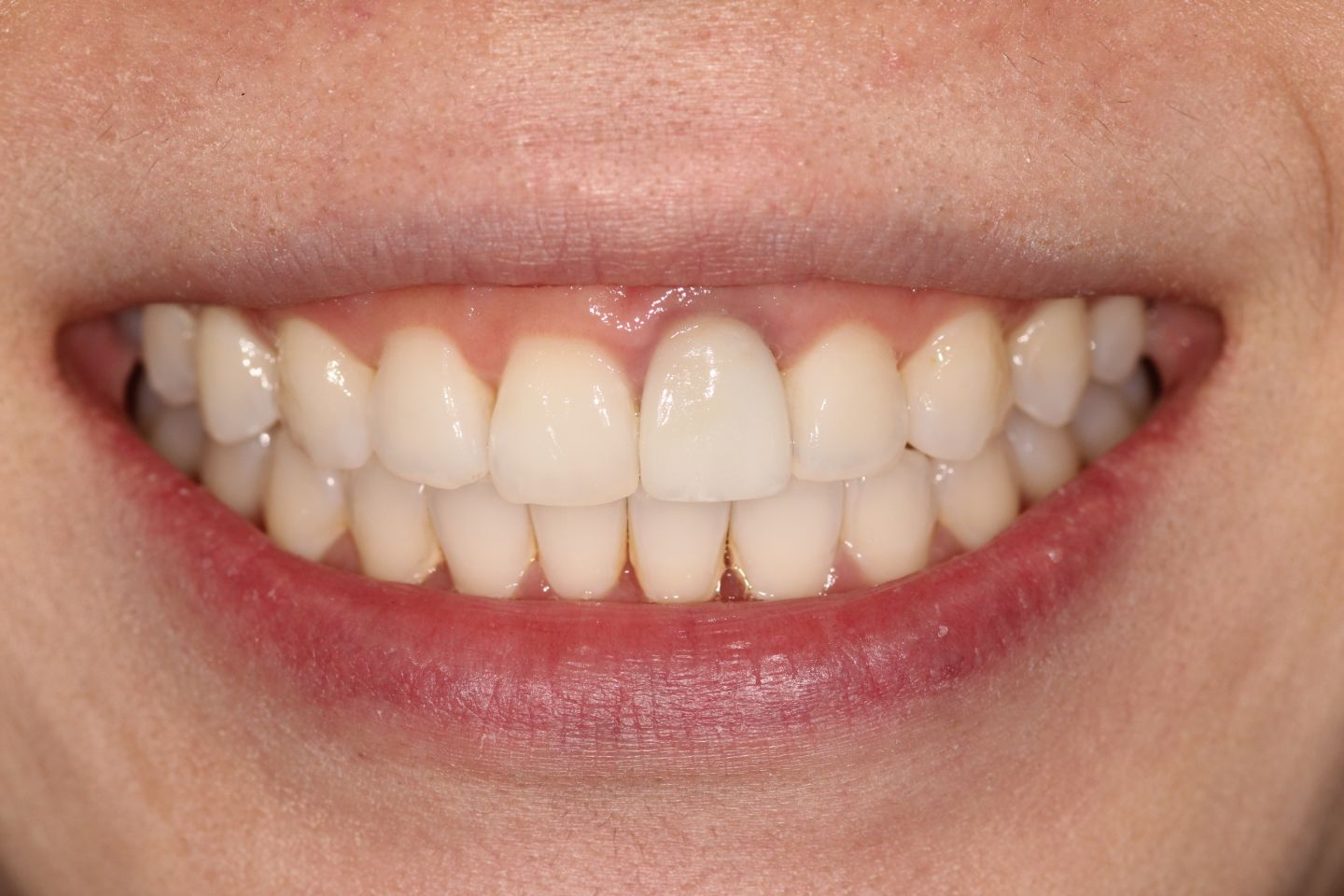 Annabelle - Invisalign, whitening, iTero and crown