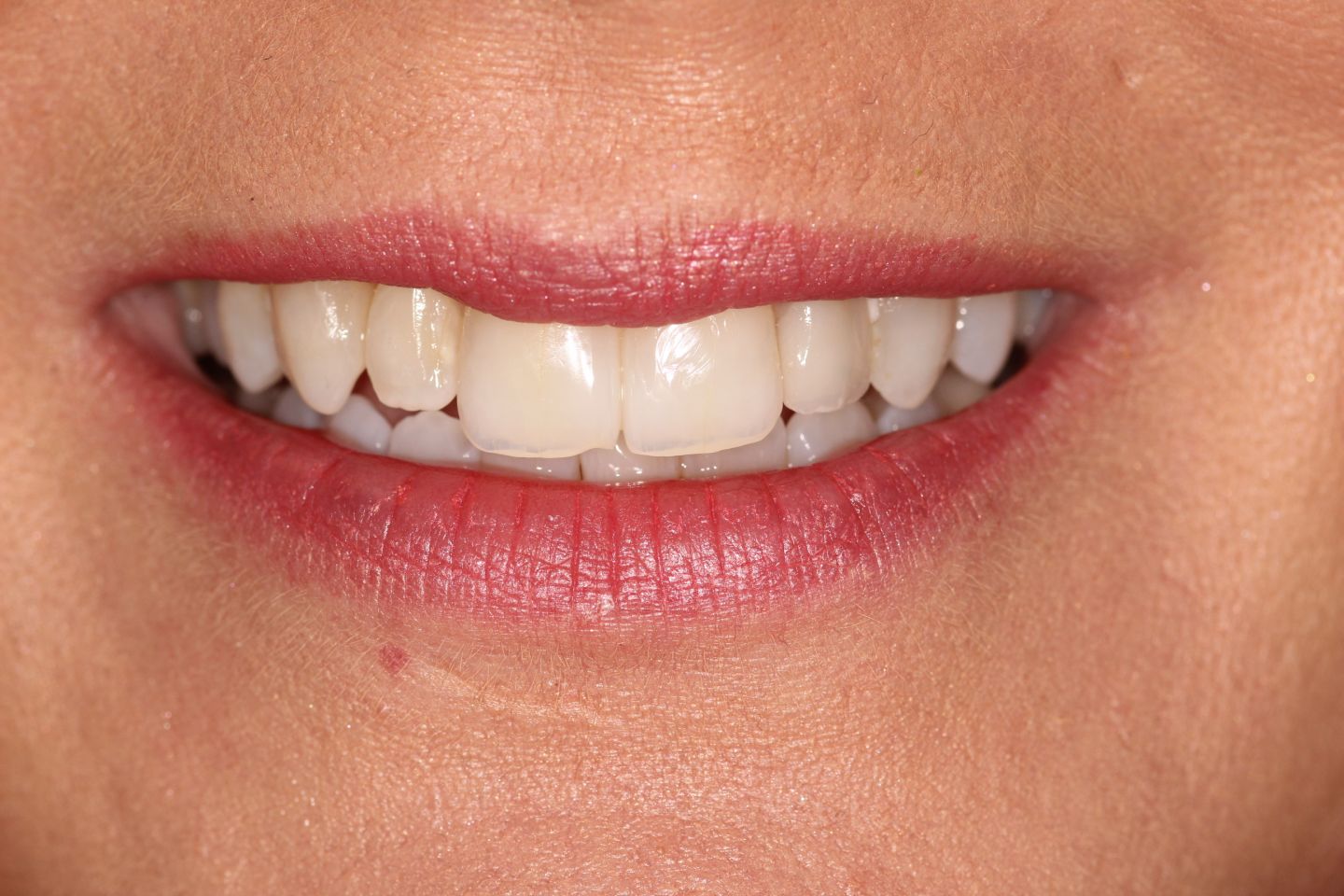 Fiona - Hygiene, Invisalign, white fillings, whitening and crowns