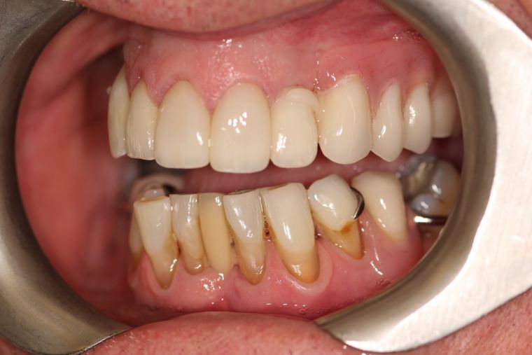 After Dentures